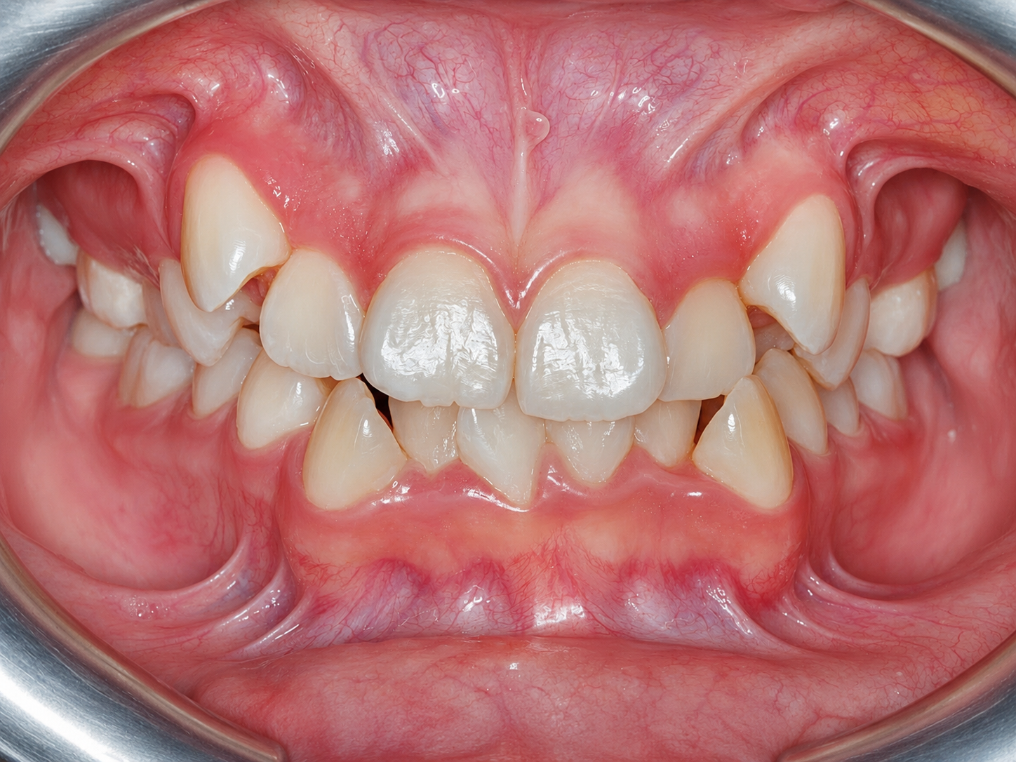 Imagen clínica de Dientes apiñados o con espacios