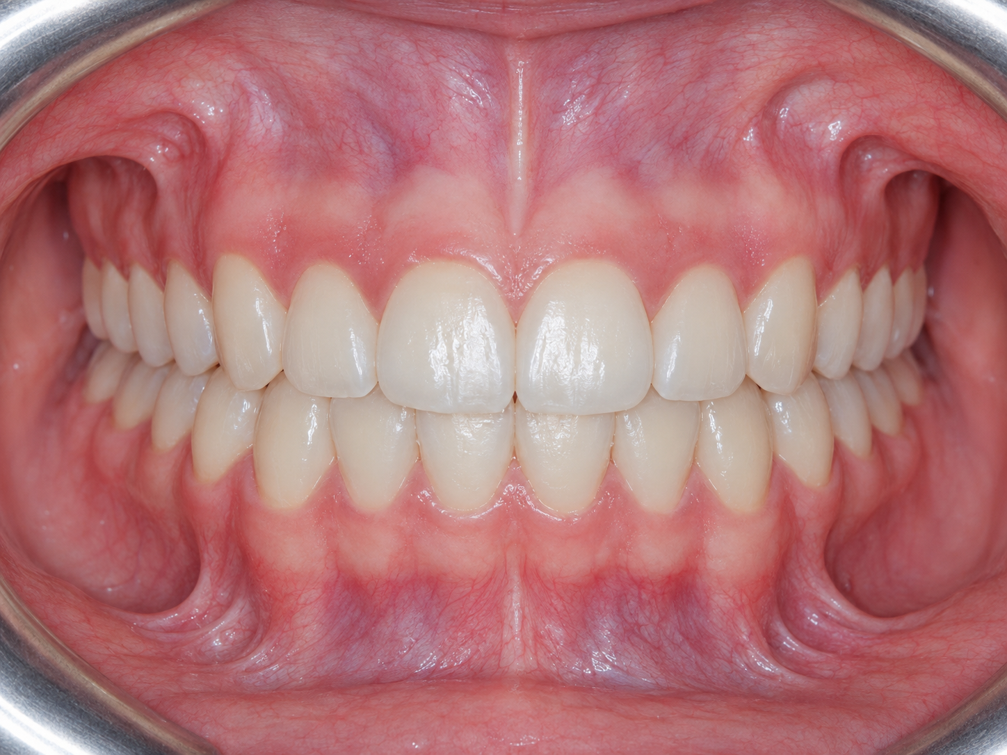 Imagen clínica de Deseo de mejorar función y estética